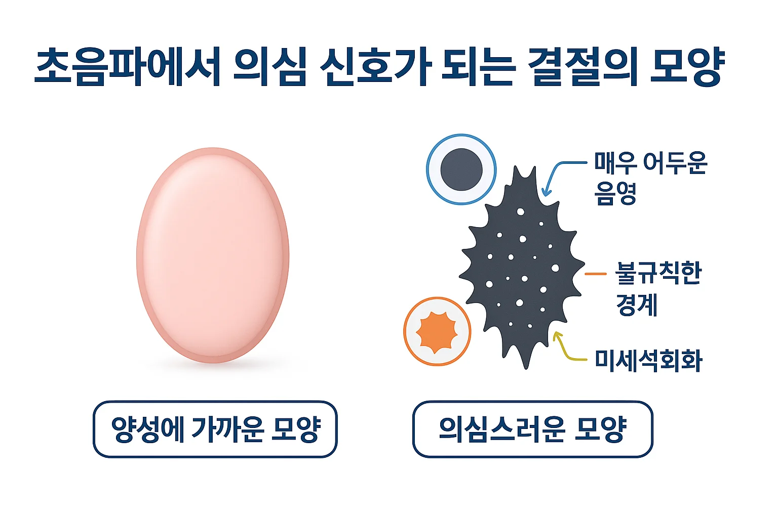 초음파에서 양성에 가까운 결절 모양과 의심스러운 결절 모양을 비교한 모식도