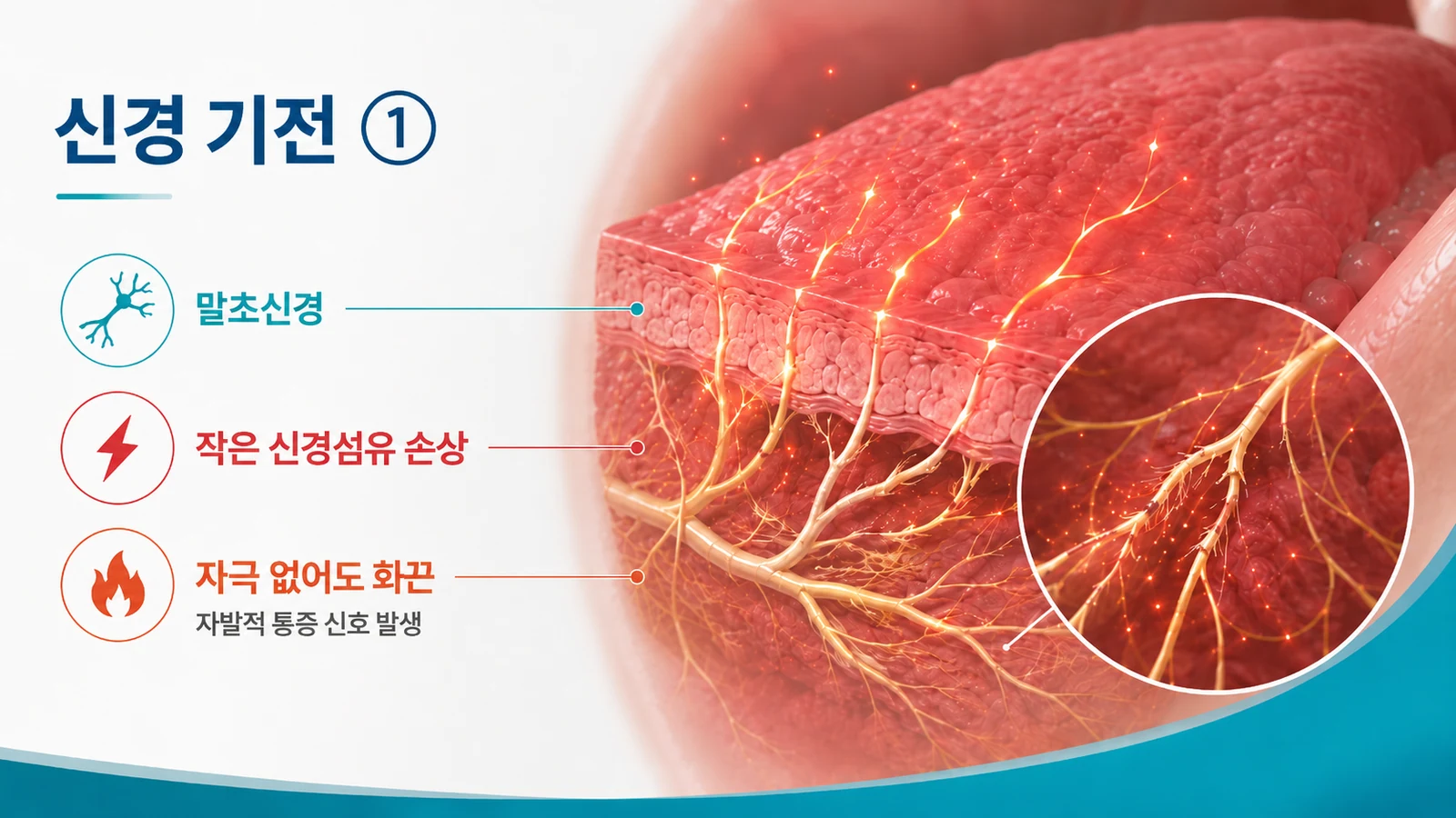말초의 작은 신경섬유 손상으로 자극 없이도 화끈거림 신호가 발생하는 기전