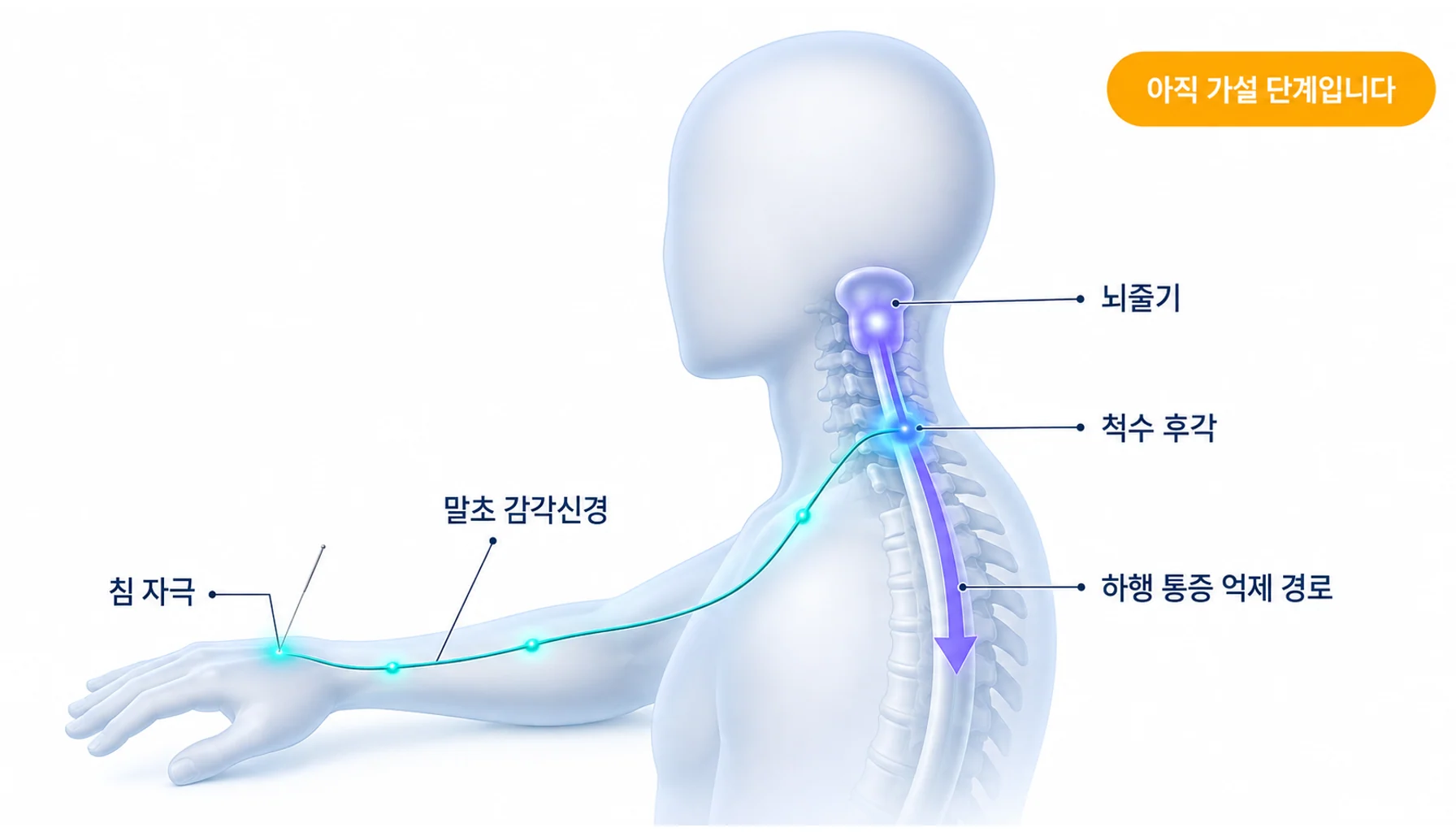 침 자극이 말초 감각신경에서 척수 후각과 뇌줄기를 거쳐 하행 통증 억제 경로를 활성화하는 과정 도식