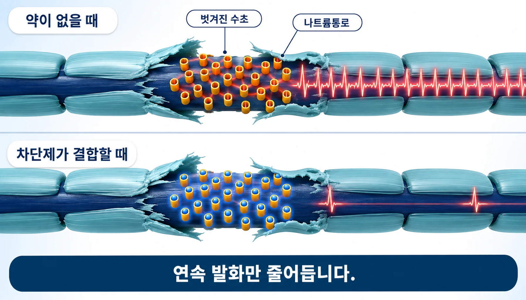 삼차신경 탈수초 부위의 이상 발화와 나트륨통로 차단제의 작용 지점