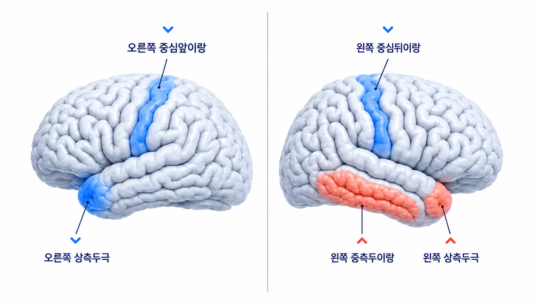 삼차신경통 환자에서 변화가 확인된 다섯 부위를 표시한 대뇌 도식