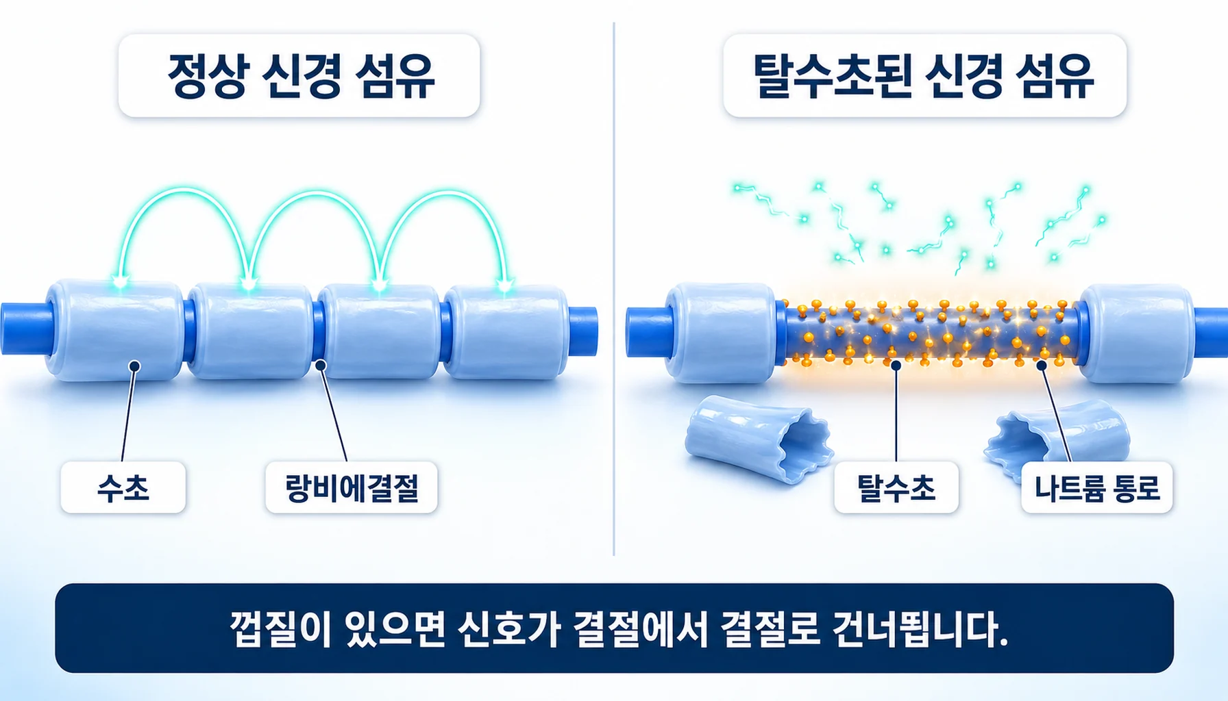 정상 유수 신경 섬유의 수초와 랑비에결절, 탈수초된 축삭의 대비 도식