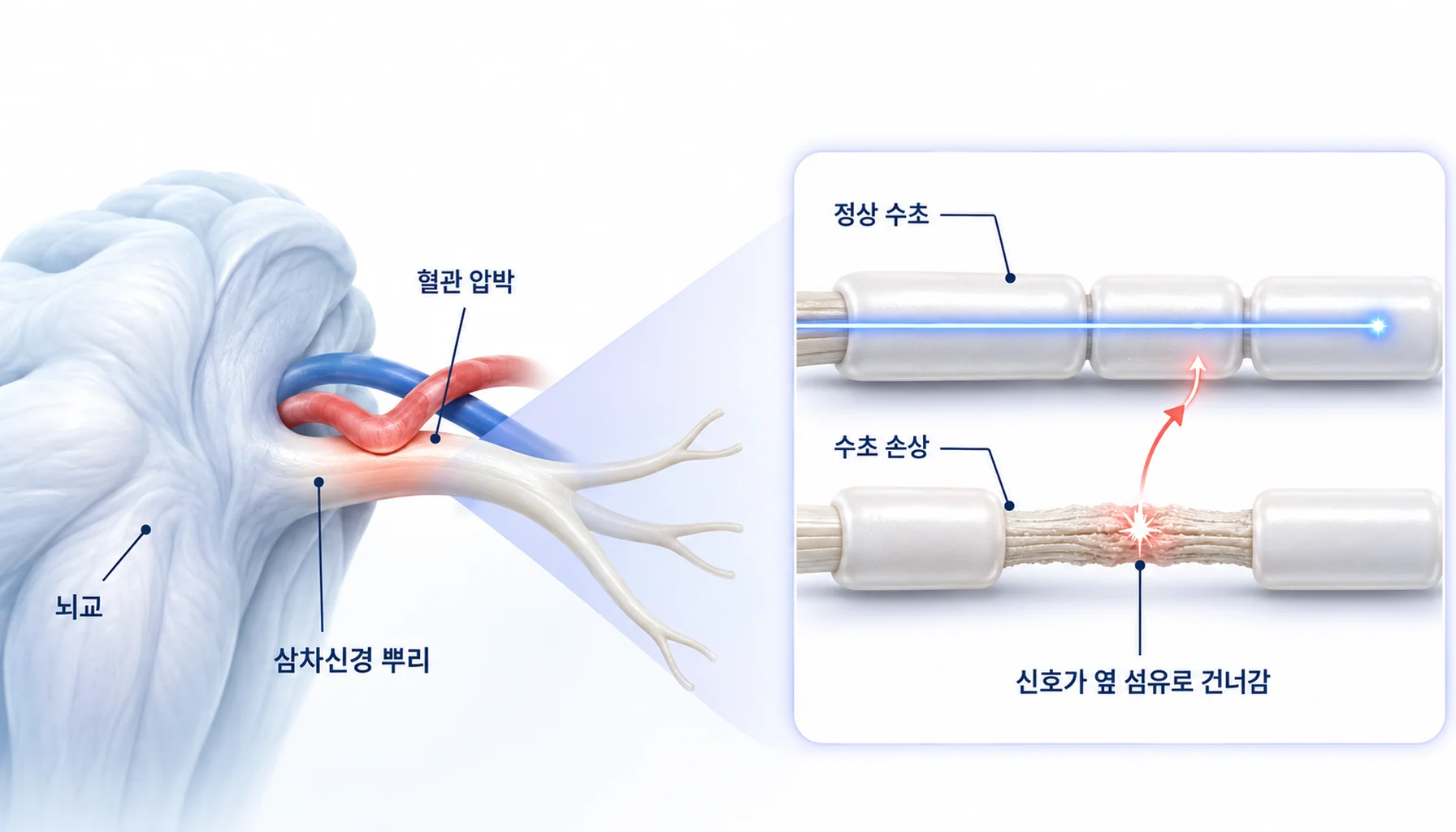 신경혈관 압박과 탈수초로 설명되는 삼차신경병증 통증의 발생 구조