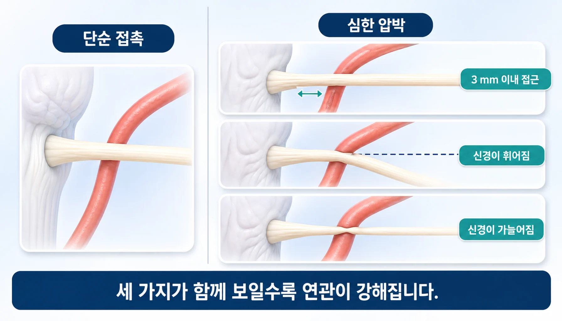 단순 접촉과 심한 압박을 구분하는 세 가지 기준을 나타낸 그림