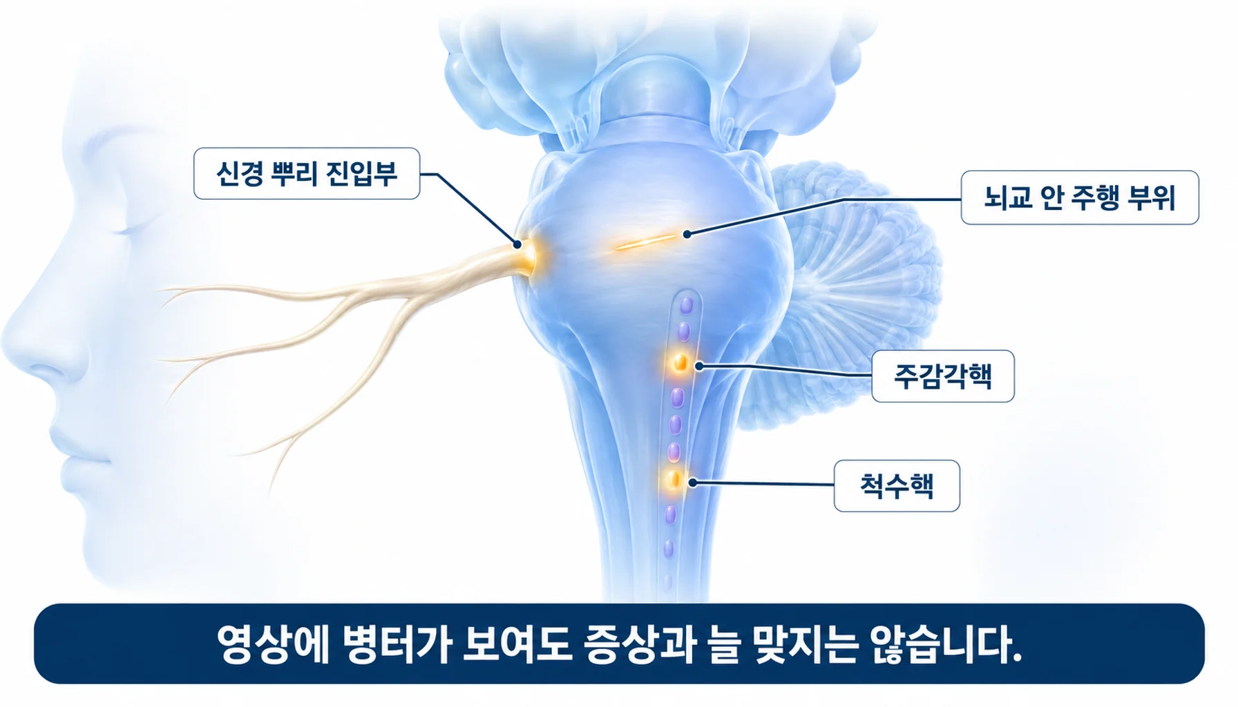 다발성경화증에서 관찰되는 삼차신경 경로의 탈수초 병터 위치를 나타낸 그림