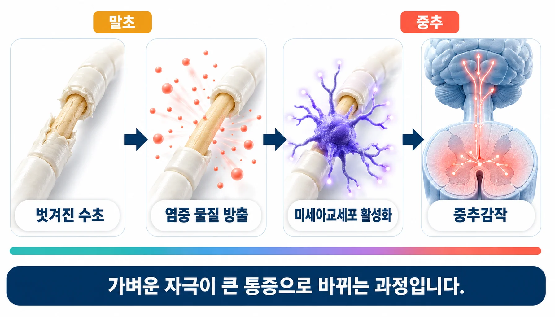 말초 삼차신경의 탈수초에서 시작된 신호가 미세아교세포 활성화를 거쳐 중추감작으로 넘어가는 단계 모식도