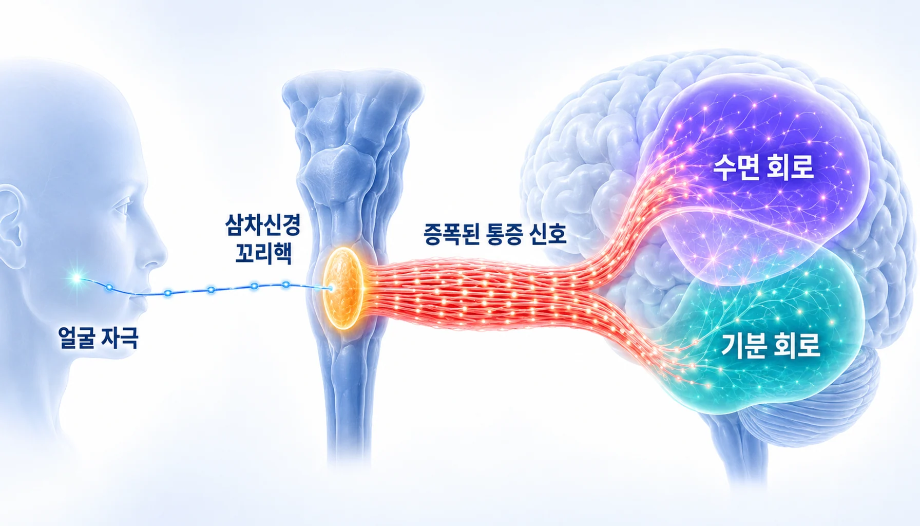 말초 통증 신호가 삼차신경 꼬리핵에서 증폭되어 정서·수면 회로와 겹치는 경로를 보여주는 도해