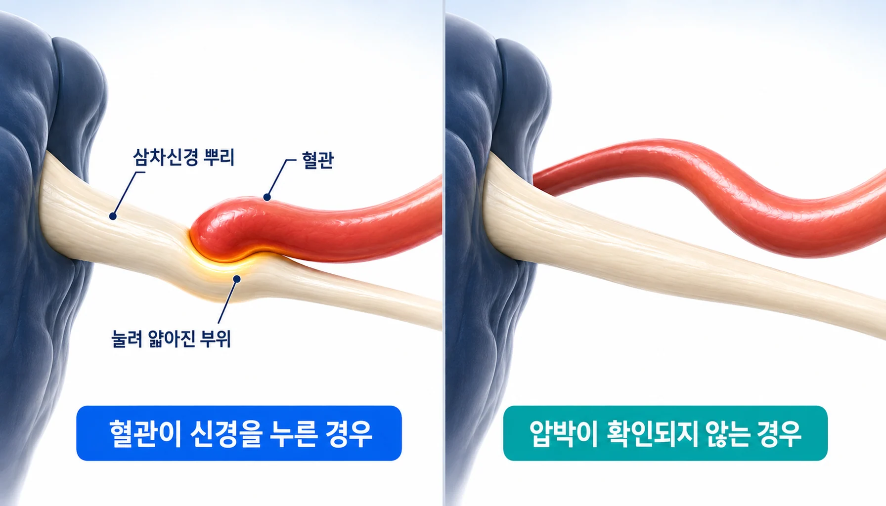 삼차신경 뿌리를 누르는 혈관과 압박이 확인되지 않는 신경을 나란히 비교한 단면 그림