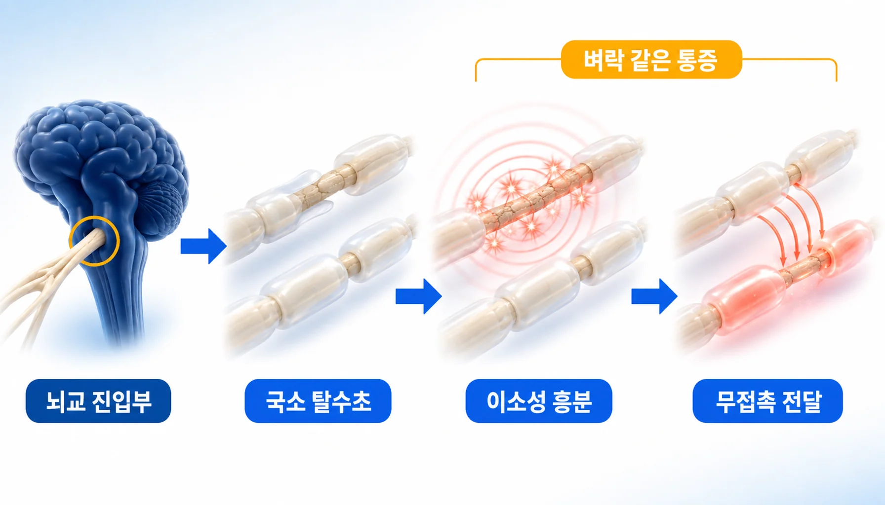 뇌교 진입부의 국소 탈수초에서 이소성 흥분과 무접촉 전달이 발생하는 과정을 단계별로 표현한 그림