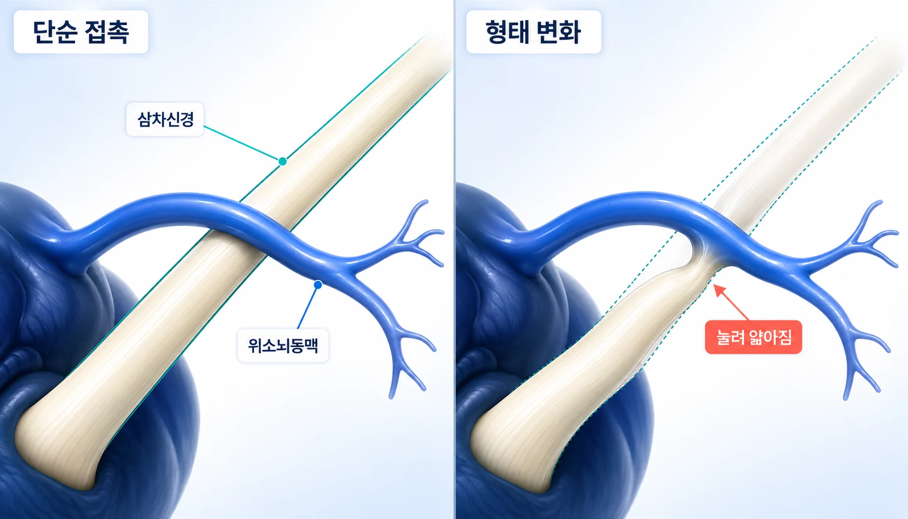 삼차신경과 위소뇌동맥의 접촉을 단순 접촉과 형태 변화 두 가지로 나누어 비교한 해부 구조 그림