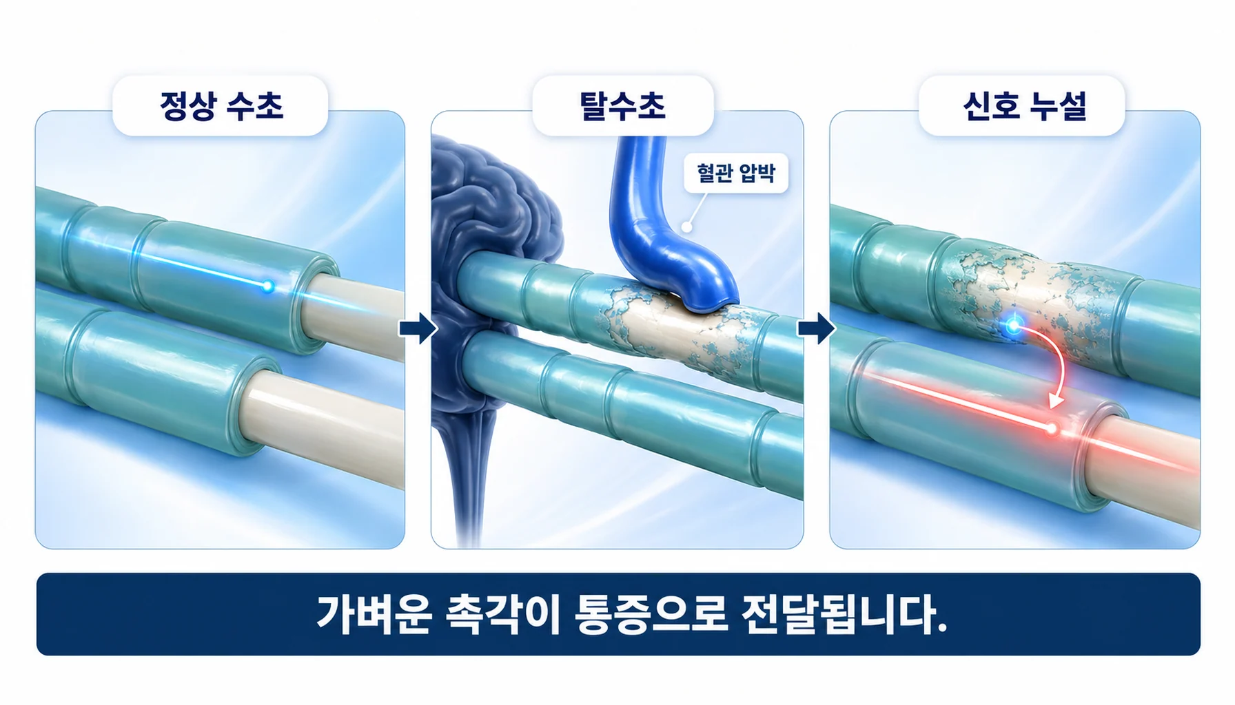 혈관 압박으로 삼차신경의 수초가 얇아지면서 인접 신경섬유로 신호가 새어 나가는 과정을 단계별로 그린 기전 그림