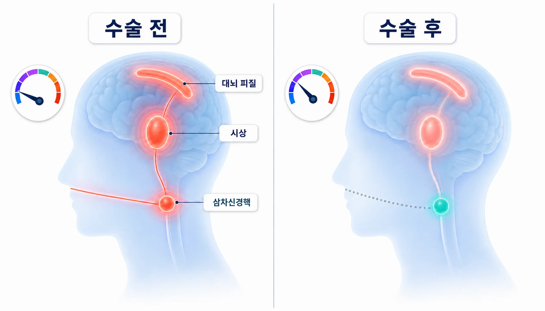 중추감작으로 삼차신경핵과 시상, 대뇌 피질의 통증 처리 문턱값이 낮아진 상태를 수술 전후로 비교한 그림