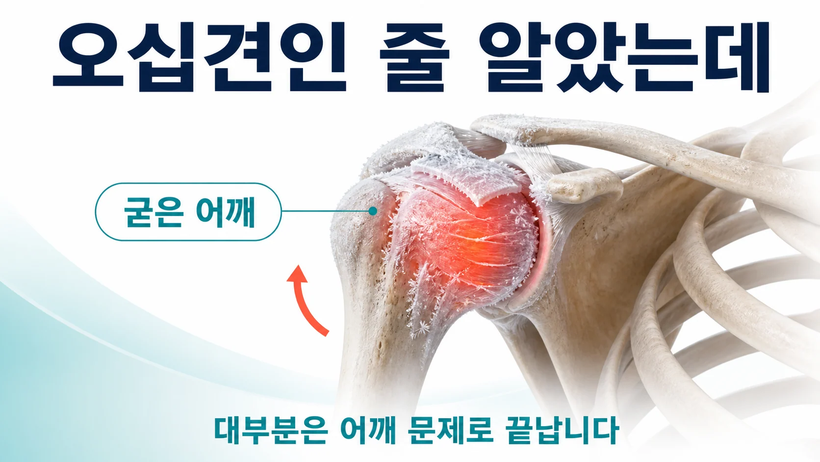 송도 이레한의원에서 파킨슨병 전구 증상으로서의 어깨 굳음을 설명하는 안내 이미지