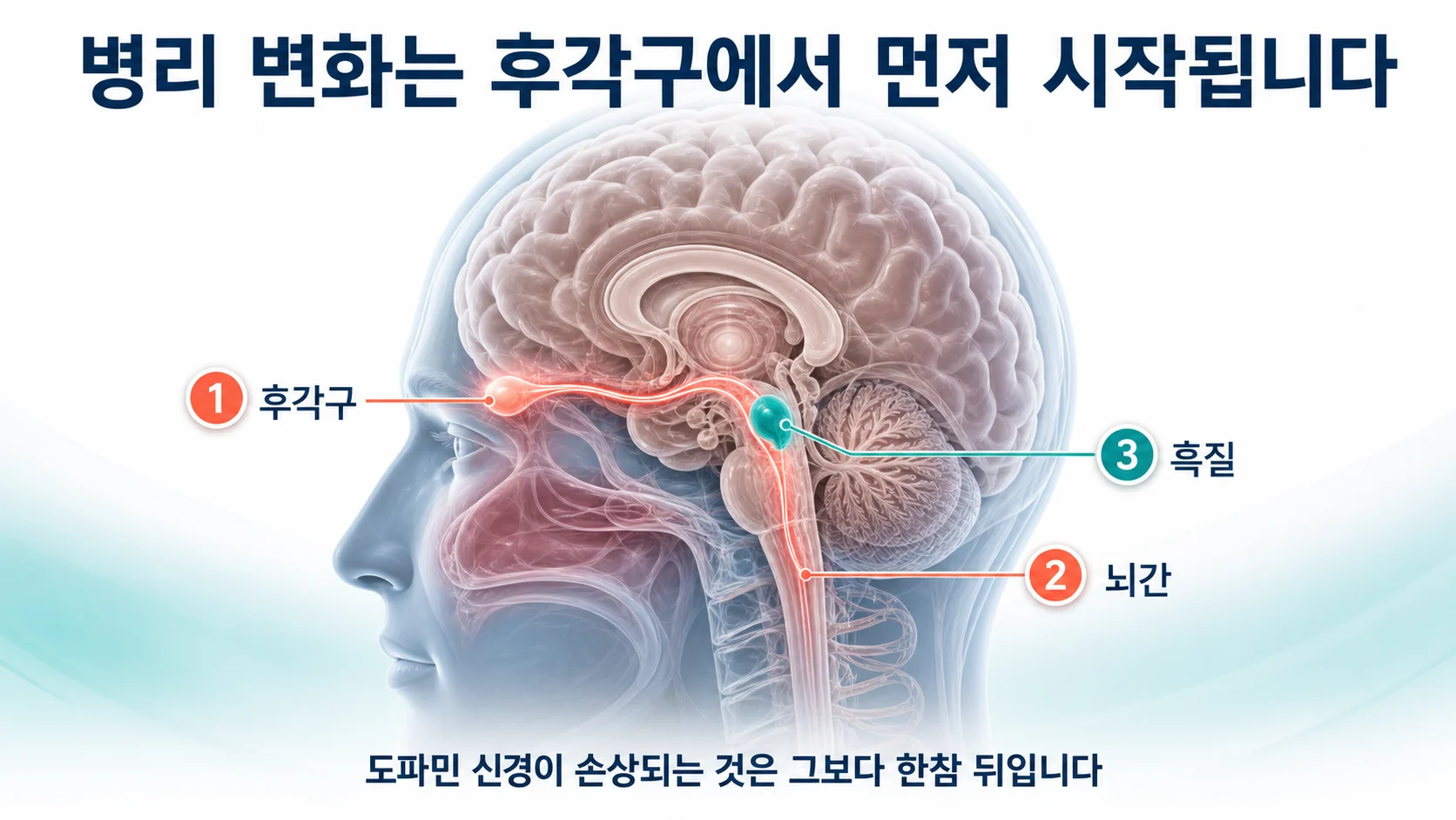 후각구에서 시작해 흑질로 번지는 신경 퇴행 경로를 단계별로 표시한 도식