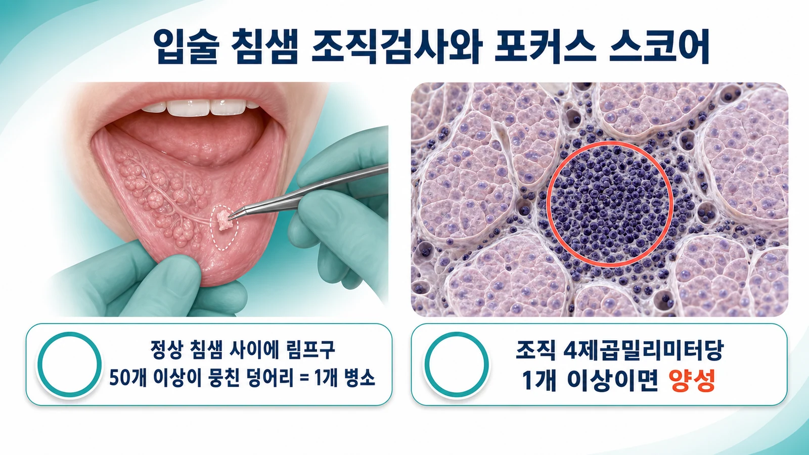 입술 안쪽에서 작은 침샘 조직을 떼어 현미경으로 림프구 침윤을 세는 포커스 스코어 검사를 설명하는 인포그래픽