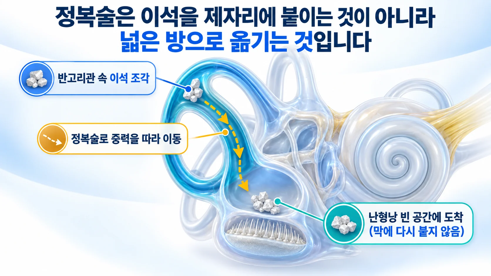 반고리관 속 이석 조각이 정복술로 중력을 따라 이동해 난형낭 빈 공간에 도착하는 경로를 보여 주는 3D 도식