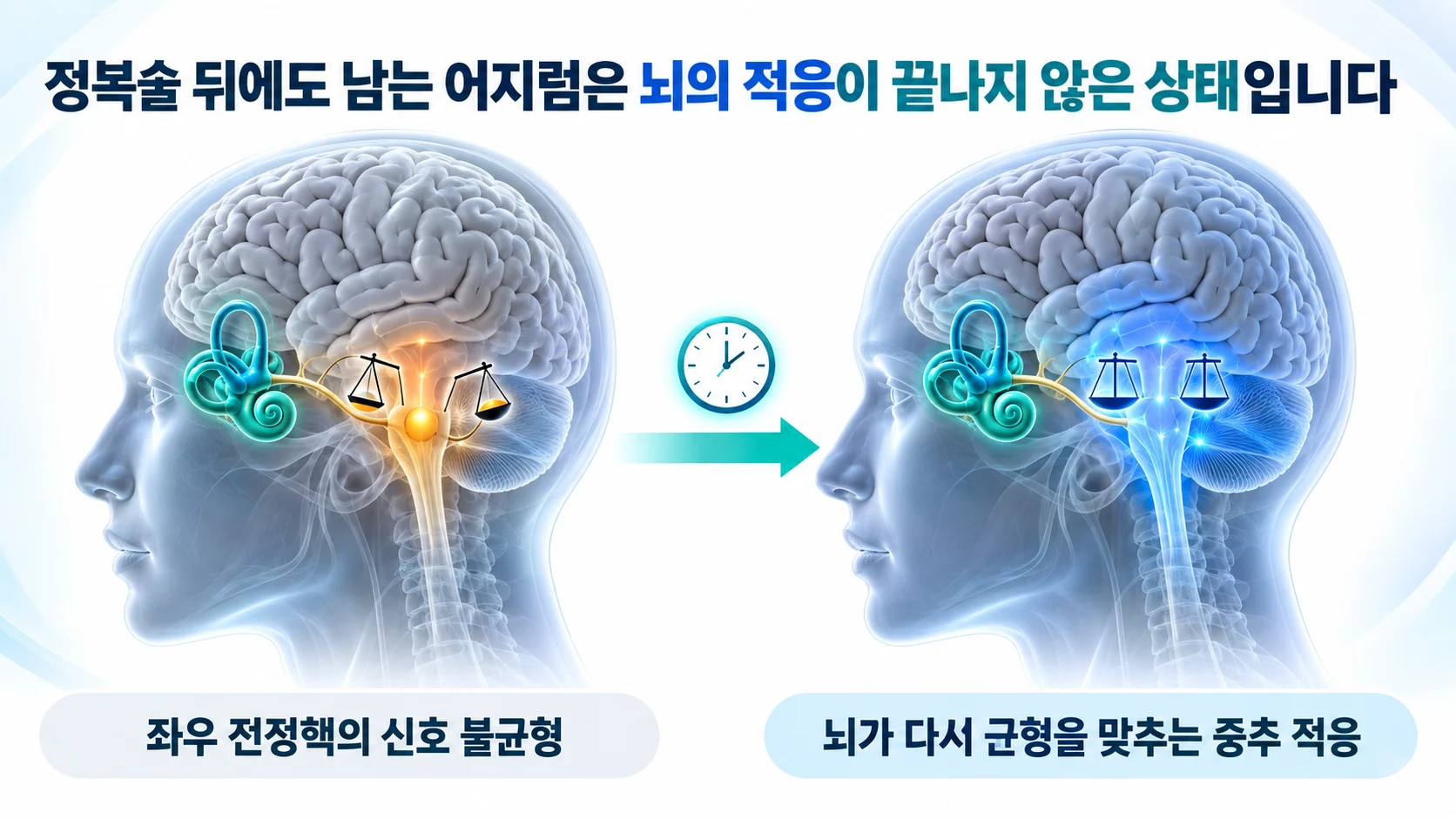 좌우 전정핵의 신호 불균형이 뇌의 중추 적응으로 다시 맞춰지는 과정을 보여 주는 두 패널 3D 그림