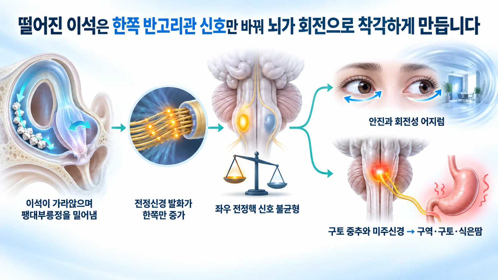 이석이 팽대부릉정을 밀어 전정신경 발화가 한쪽만 늘고 좌우 전정핵 신호가 어긋나 안진·회전성 어지럼과 구역·구토로 갈라지는 경로를 보여 주는 3D 도식