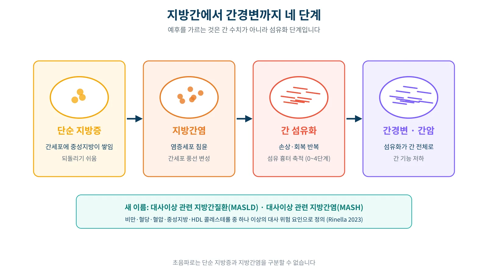 단순 지방증에서 지방간염, 간 섬유화, 간경변으로 진행하는 네 단계를 간 조직 단면으로 보여 주는 모식도