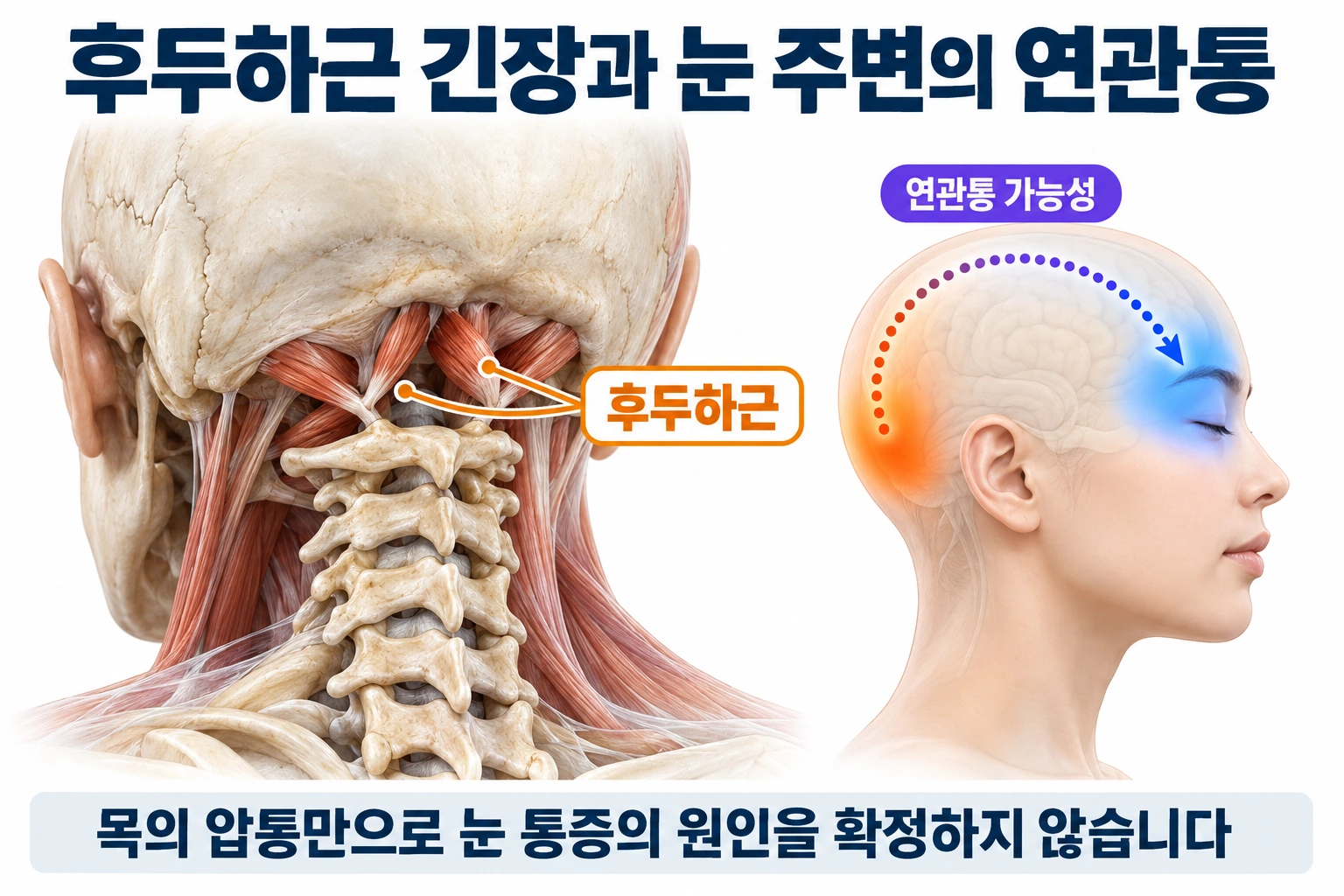 후두하근의 위치와 뒤통수에서 눈 주변으로 느껴질 수 있는 연관통의 개념도