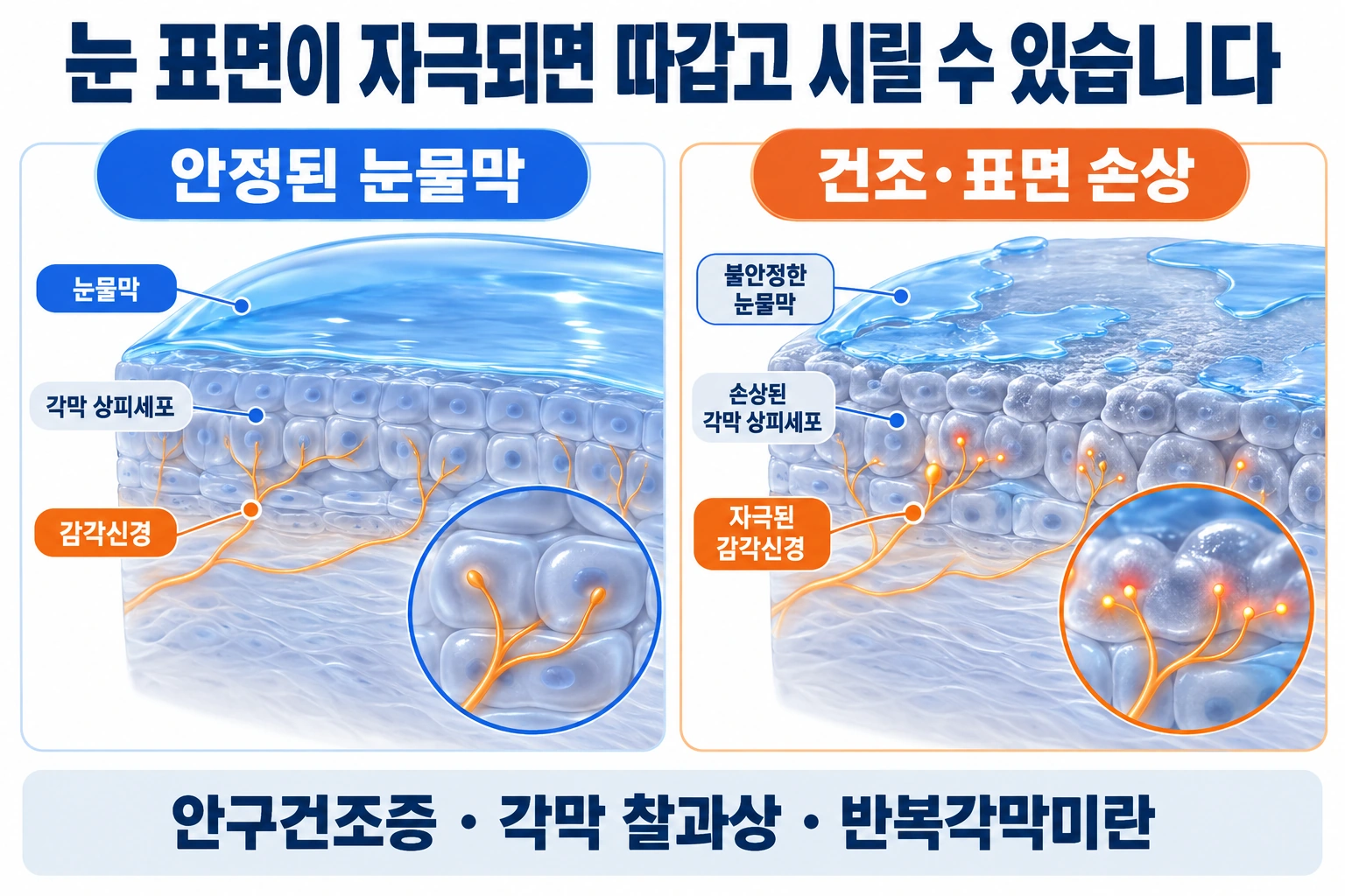 안정된 눈물막과 건조·표면 손상 상태에서 각막 감각신경이 받는 자극을 비교한 모식도