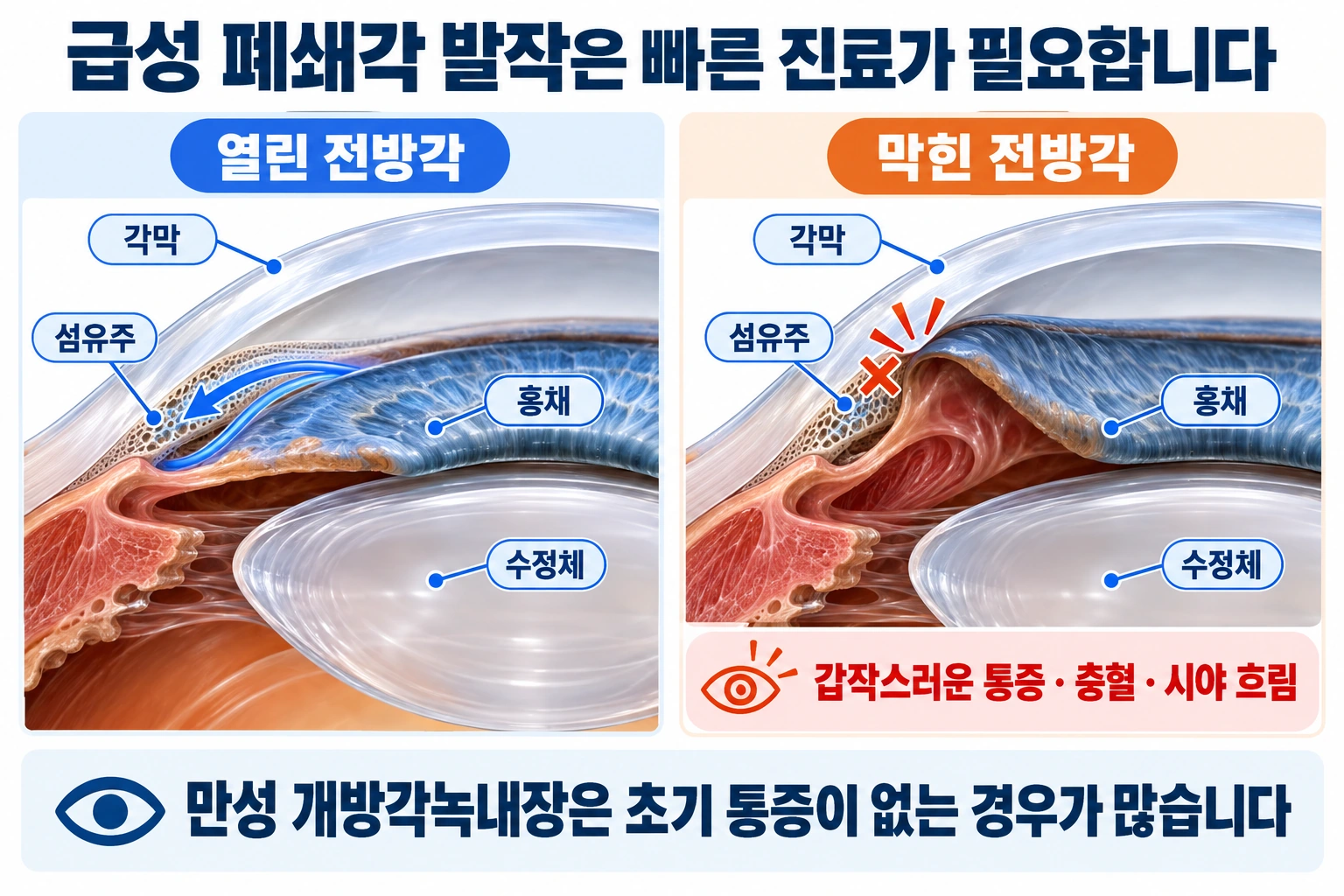 열린 전방각과 막힌 전방각을 비교하고 급성 폐쇄각 발작과 만성 개방각녹내장의 증상 차이를 설명한 그림