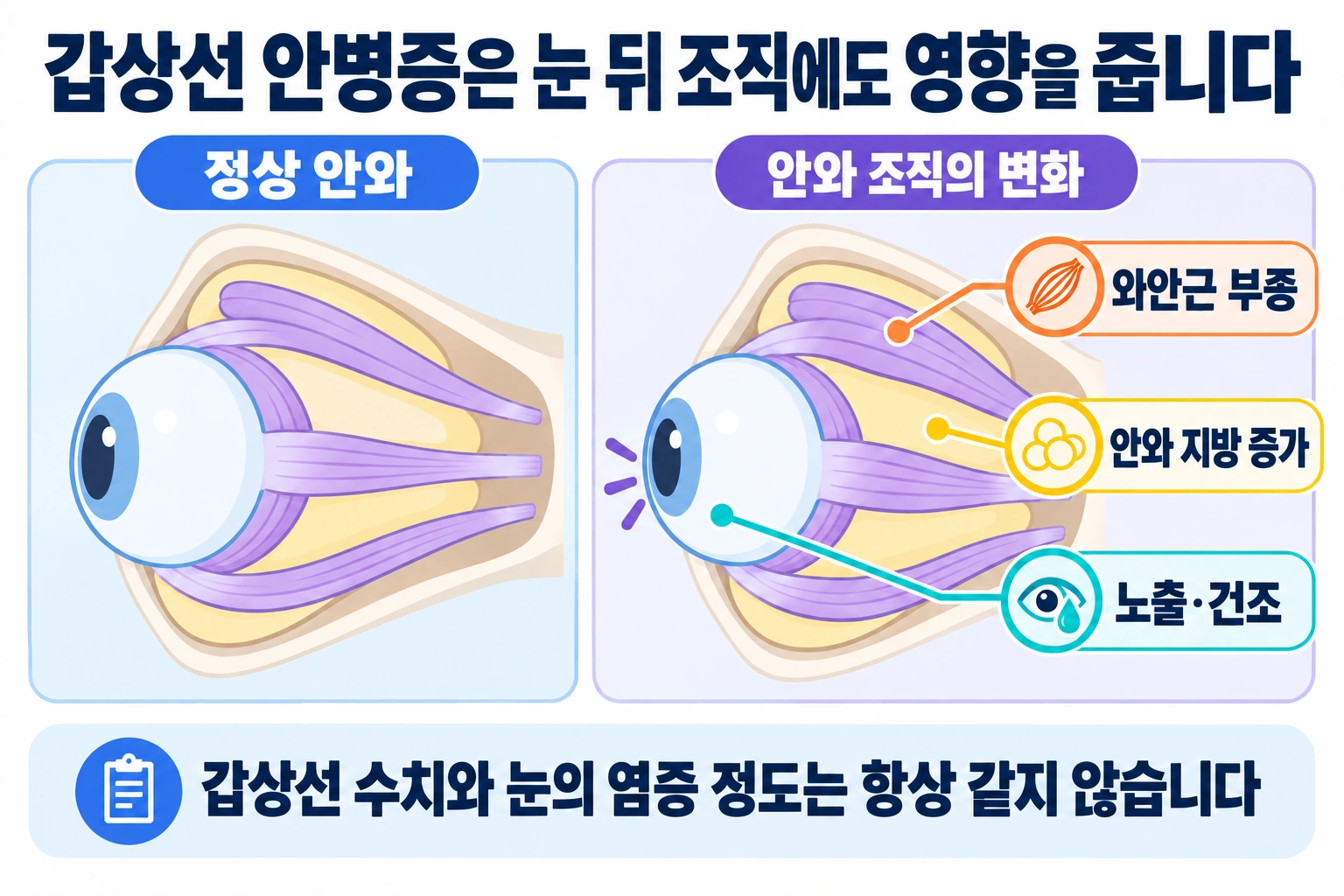 정상 안와와 갑상선 안병증에서 나타날 수 있는 외안근 부종·안와 지방 증가·눈 표면 노출 비교