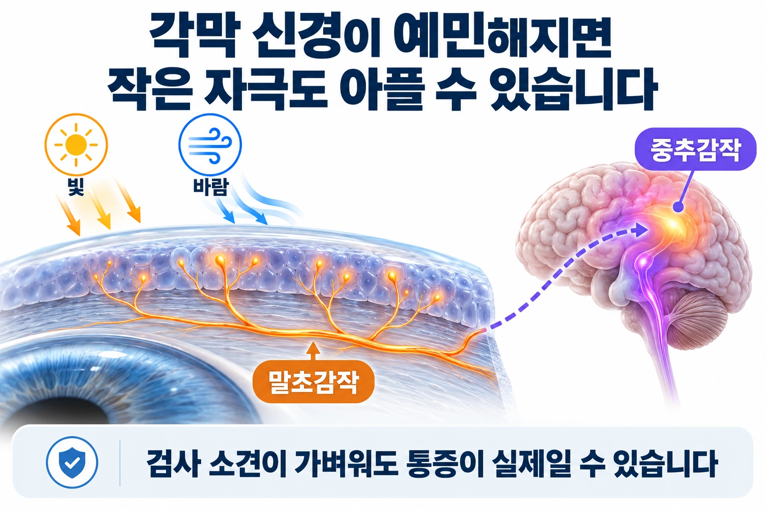 각막 감각신경의 말초감작과 중추의 통증 처리 변화를 개념적으로 설명하는 모식도