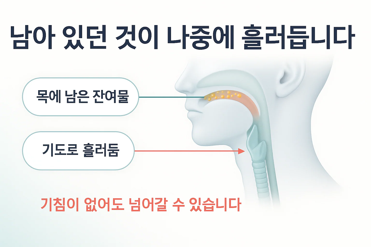 삼킴 곤란이 잔여물과 흡인으로 이어지는 과정을 나타낸 도식