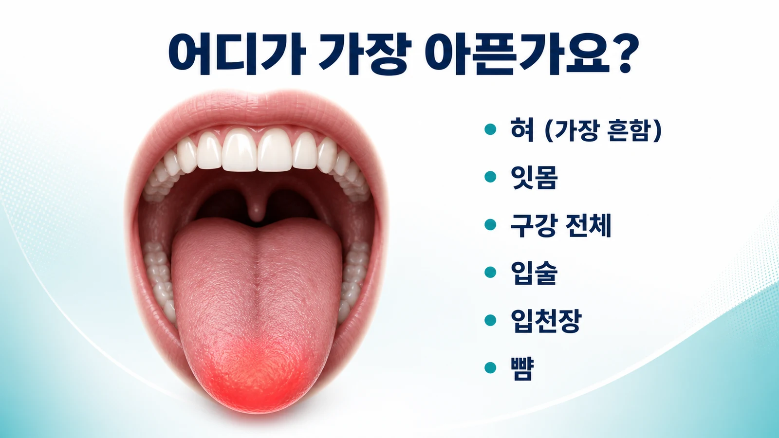 구강작열감증후군 작열감 부위 — 혀가 가장 흔함