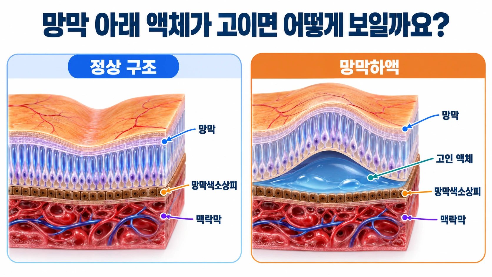 정상 망막과 중심성망막병증에서 망막 아래 액체가 고이는 구조를 비교한 의학 일러스트