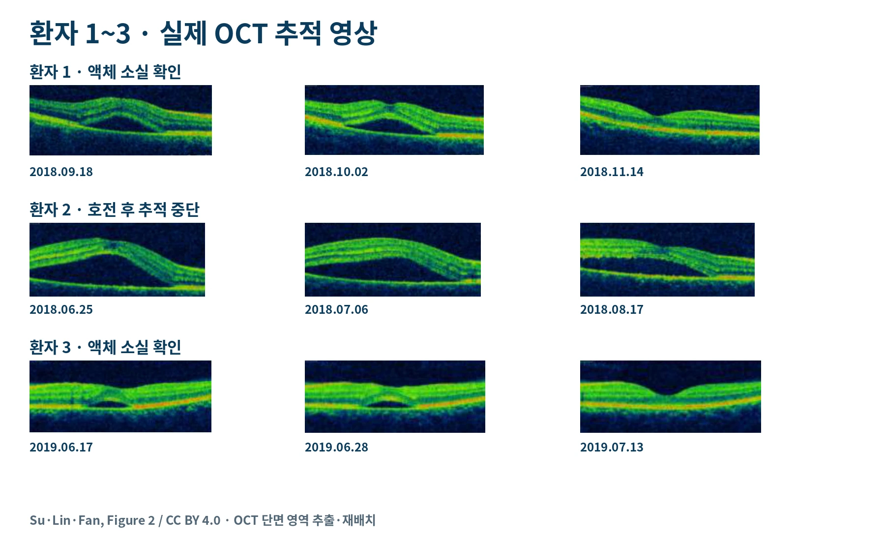 논문 환자 1번부터 3번의 실제 OCT 단면을 날짜별로 비교하고 2번의 추적 중단을 표시한 그림