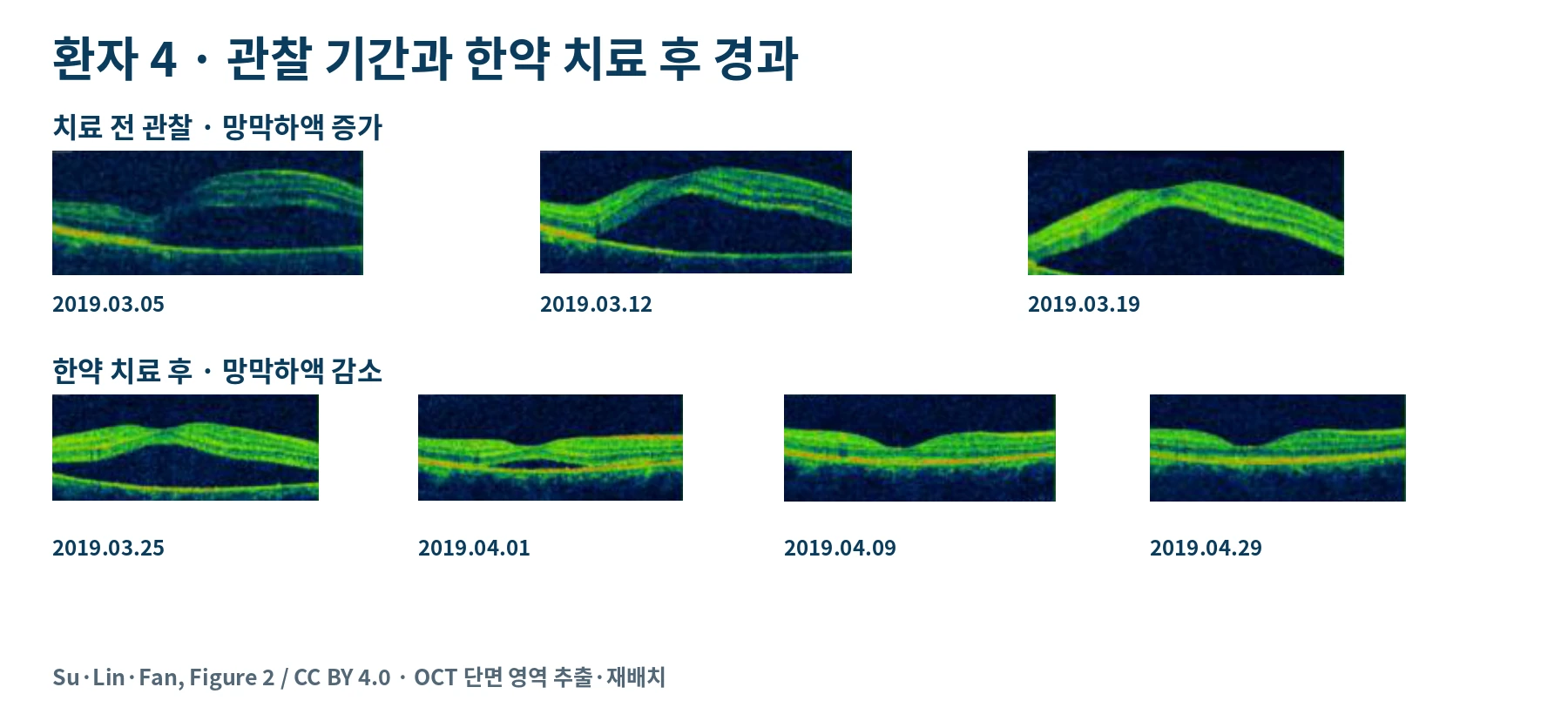 환자 4번의 치료 전 관찰 기간과 첫 치료 이후 OCT 변화를 날짜 순서로 정리한 실제 검사 영상