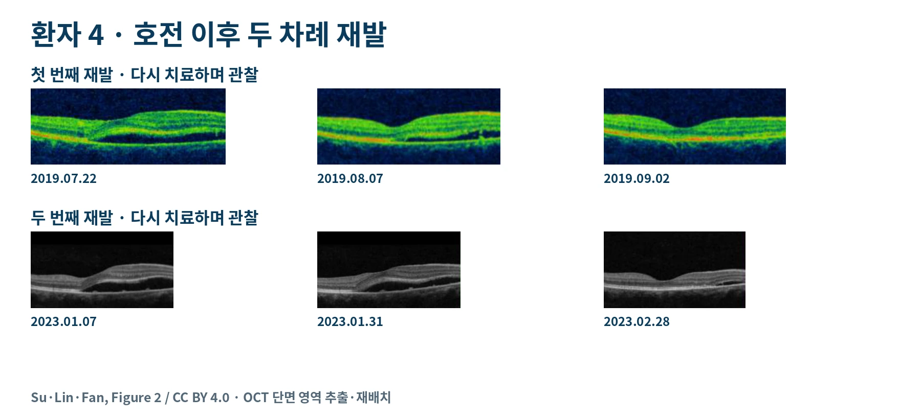 환자 4번에게 2019년과 2023년에 발생한 재발 및 이후 OCT 변화를 비교한 실제 검사 영상