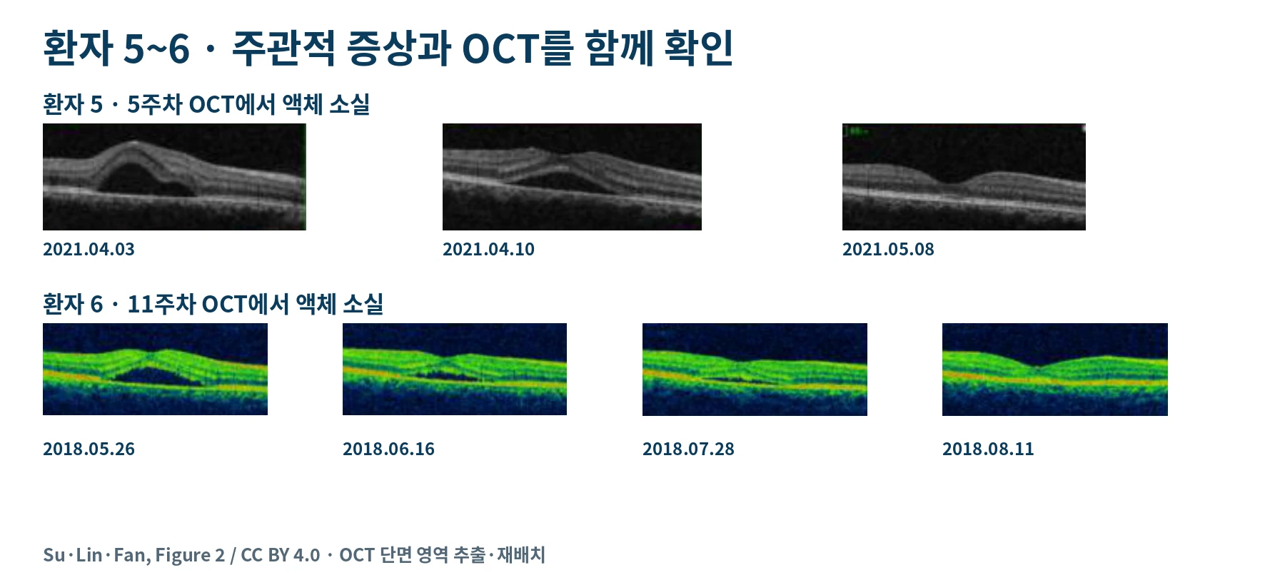환자 5번과 6번의 실제 OCT 추적 영상으로 증상 호전과 액체 소실 시점의 차이를 설명한 그림