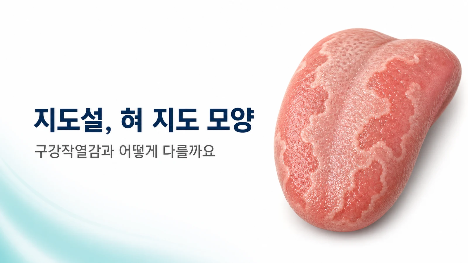 지도설(혀 지도 모양), 구강작열감과 어떻게 다를까요