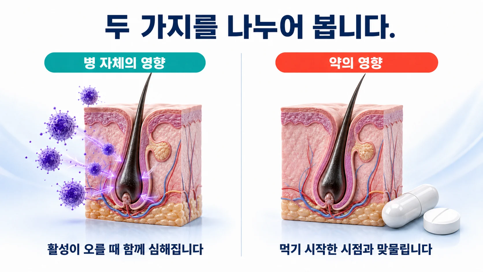 자가면역질환 자체가 모발에 영향을 주는 경로와 약물의 영향을 나란히 놓고 비교한 도식