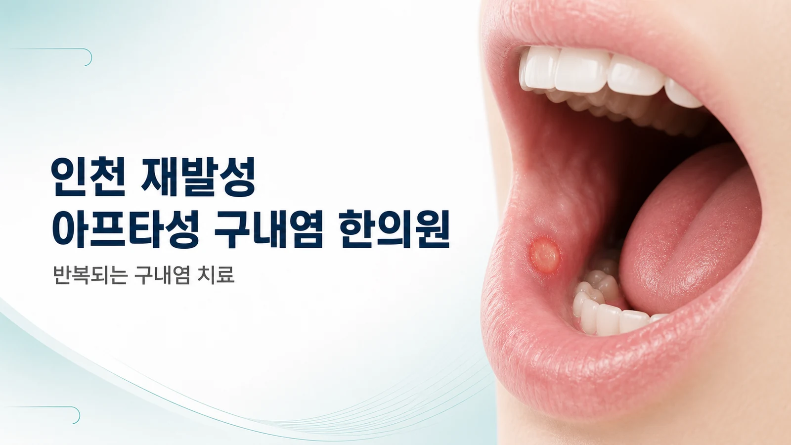 재발성 아프타성 구내염 — 반복되는 구내염 치료