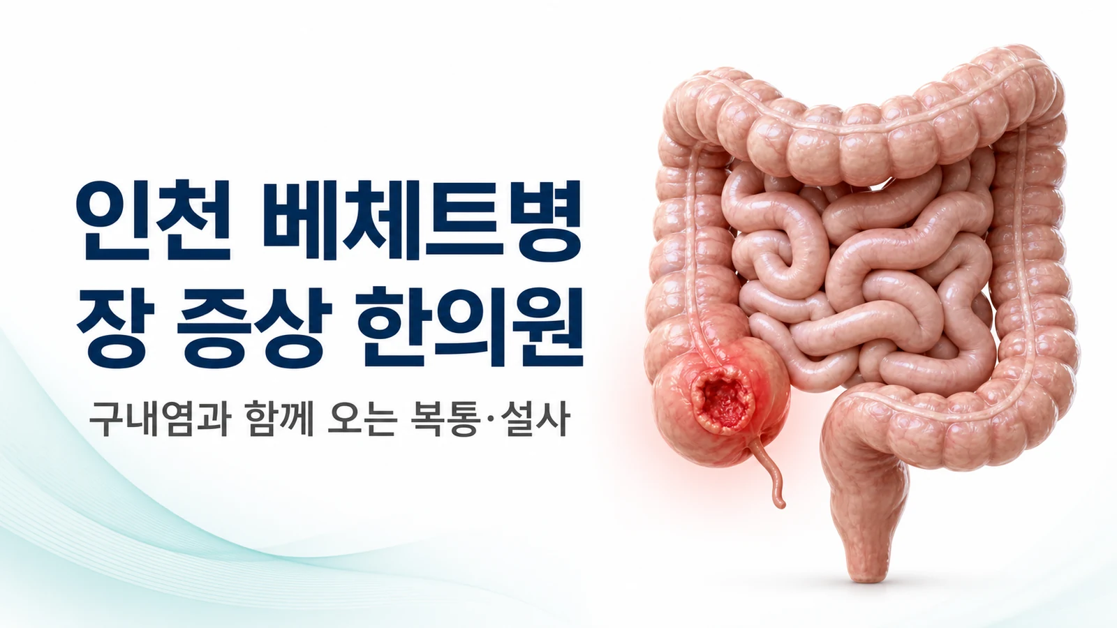 베체트병 장 증상 — 구내염과 함께 오는 복통·설사