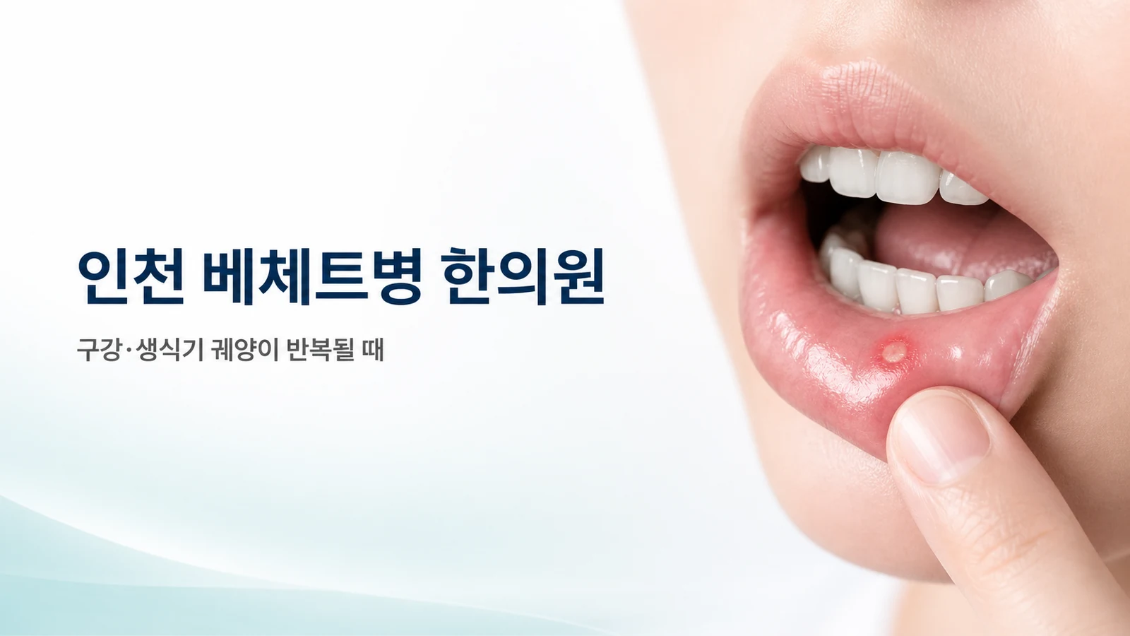 베체트병 — 구강·생식기 궤양이 반복될 때 한방 치료