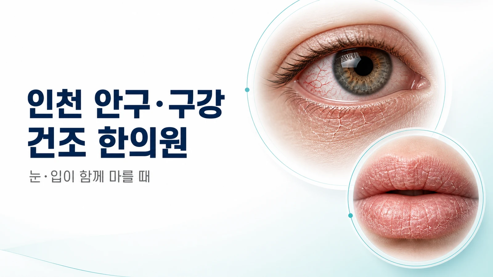 안구·구강 건조 — 눈·입이 함께 마를 때 치료