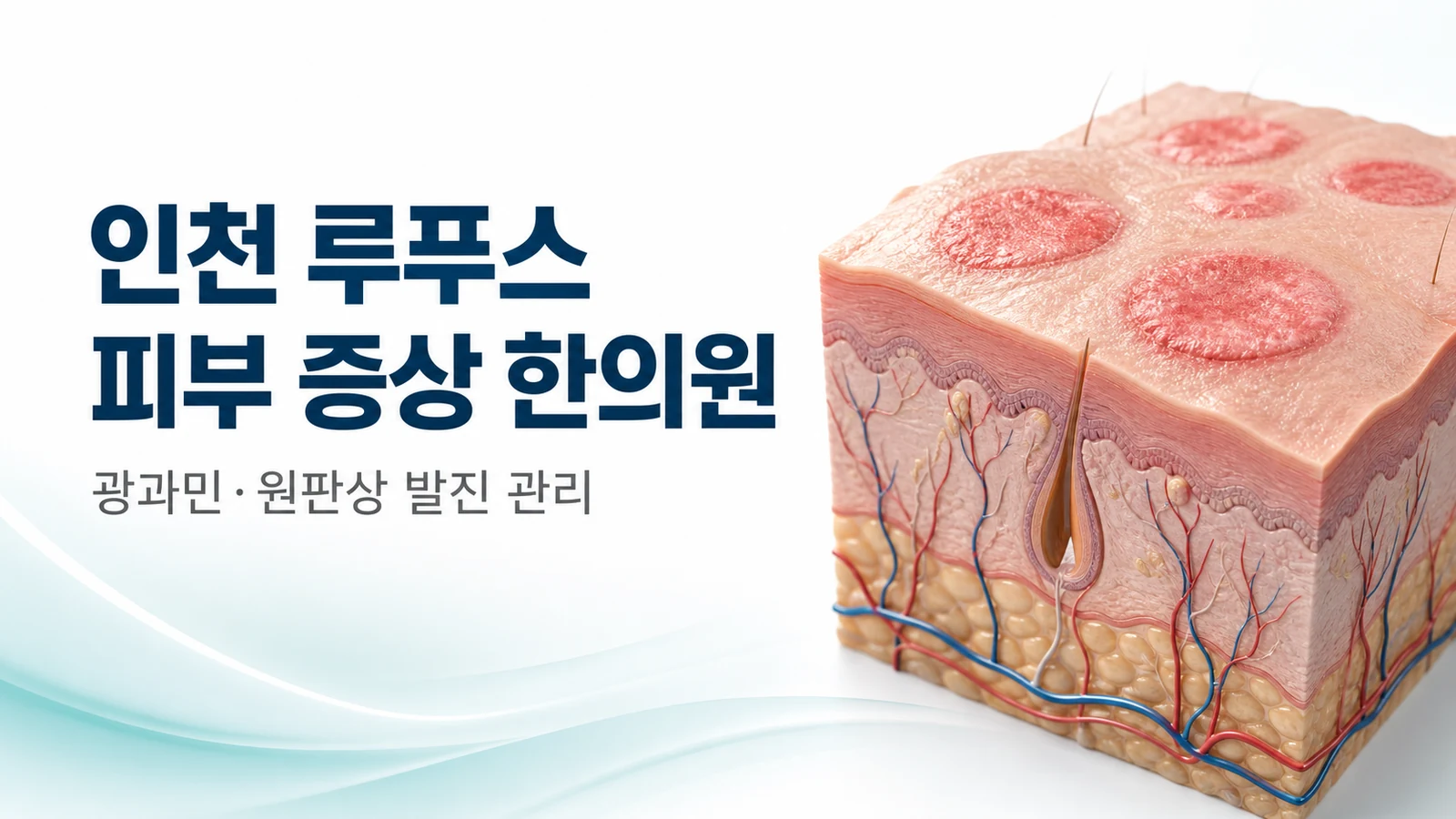 루푸스 피부 증상 — 광과민·원판상 발진 관리