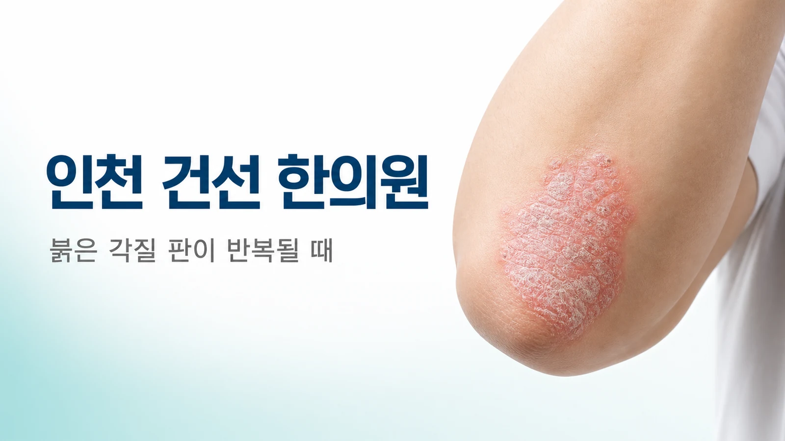인천 건선 한의원 — 붉은 각질 판이 반복될 때 한방 치료