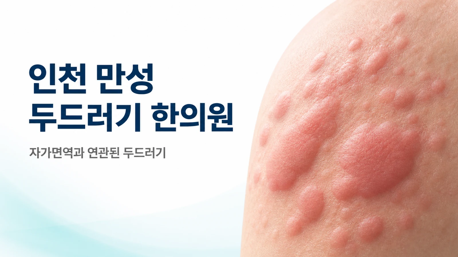 만성 두드러기 자가면역 — 항히스타민제로 안 잡힐 때