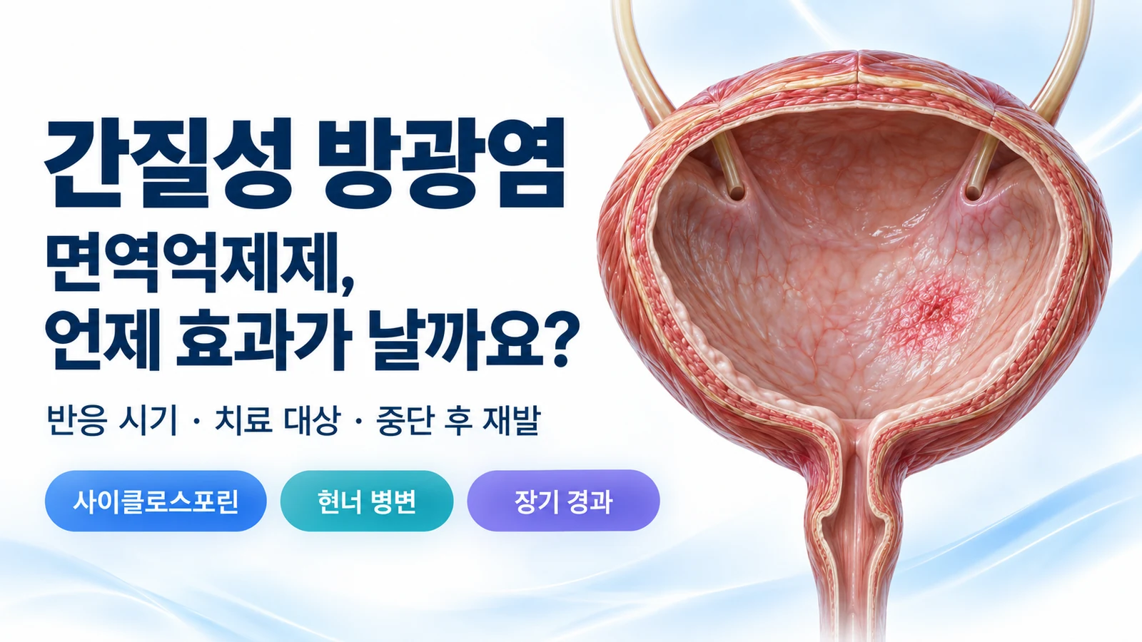 간질성 방광염, 면역억제제 효과는 언제?