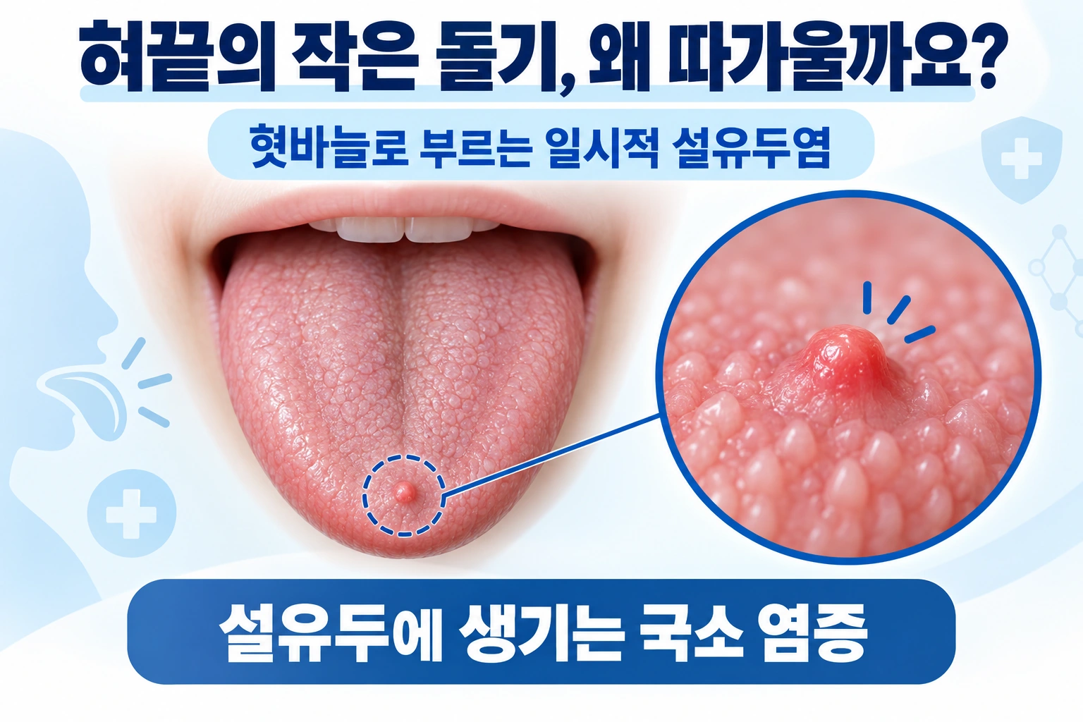 혀끝 통증의 원인, 혓바늘은 왜 생기고 언제 나을까요?