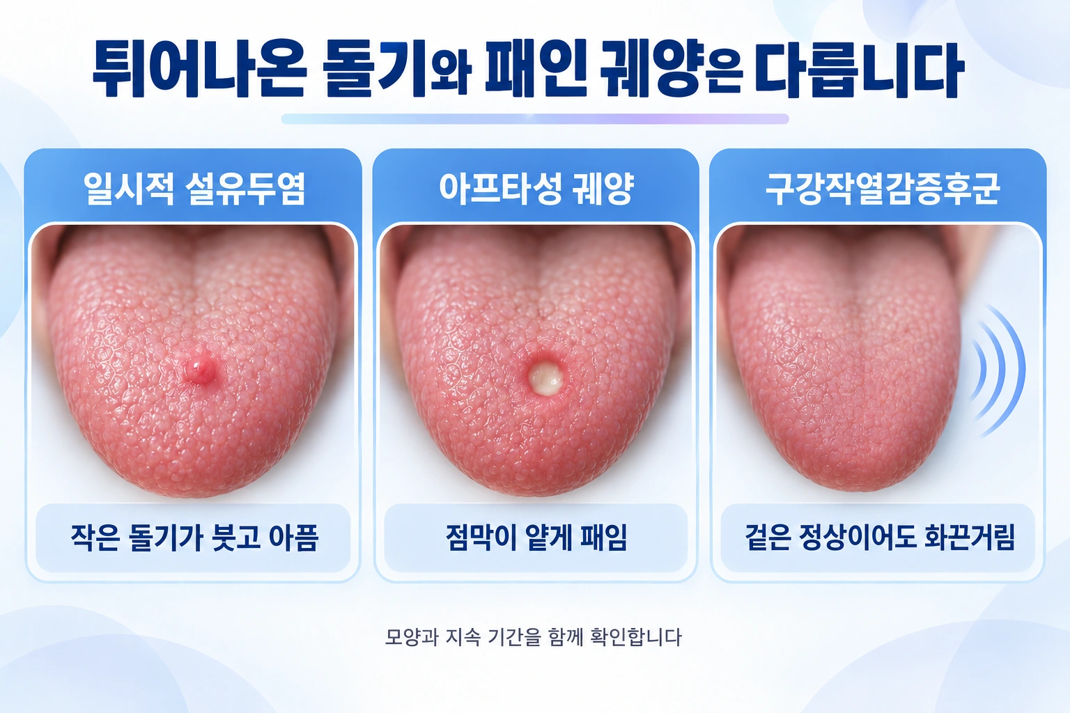 작은 돌기가 부은 모습, 점막이 패인 궤양, 정상에 가까운 혀에서 지속되는 작열감을 비교합니다.