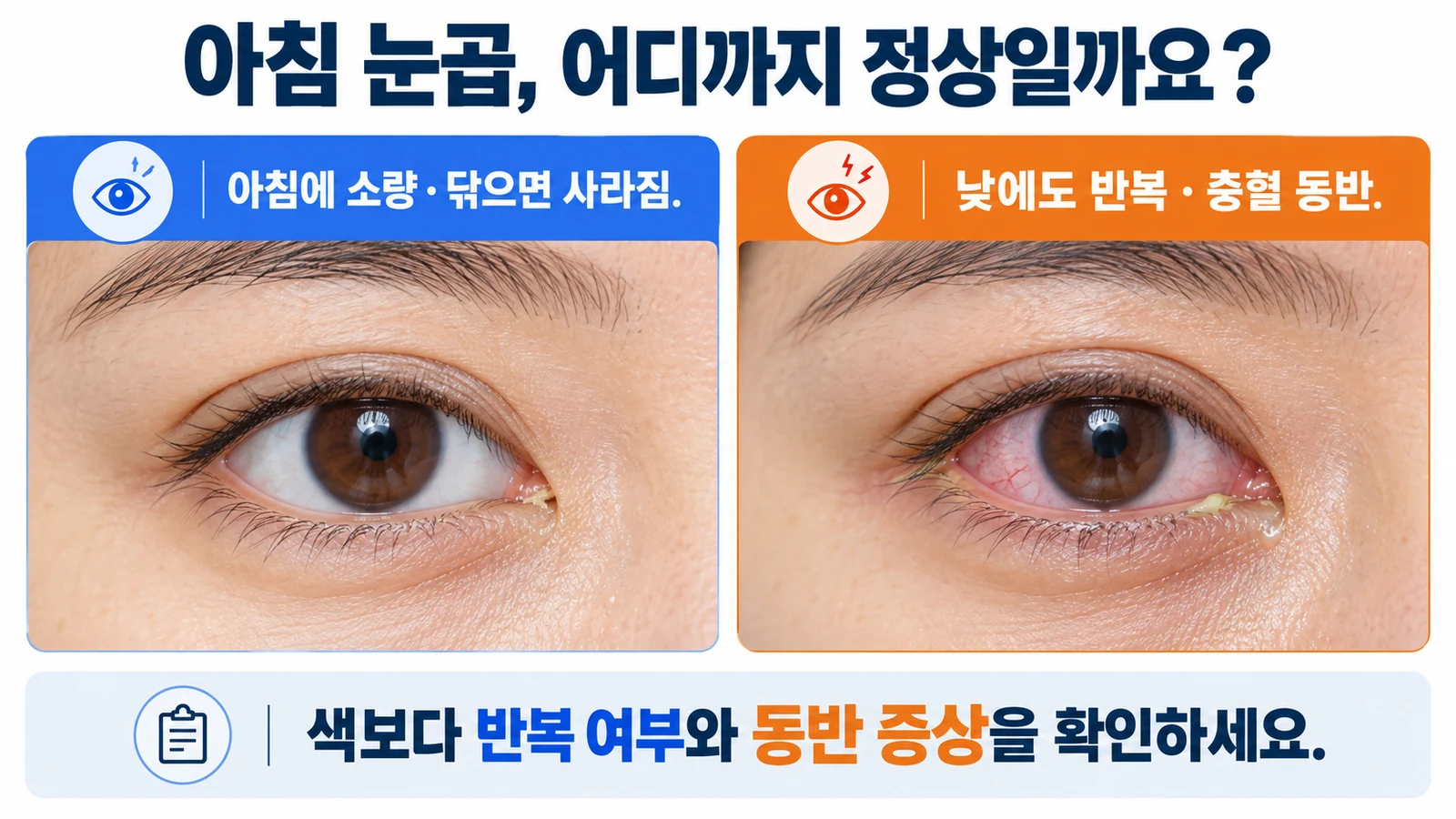 아침에 소량 생기는 눈곱과 낮에도 반복되며 충혈을 동반하는 분비물을 비교한 그림