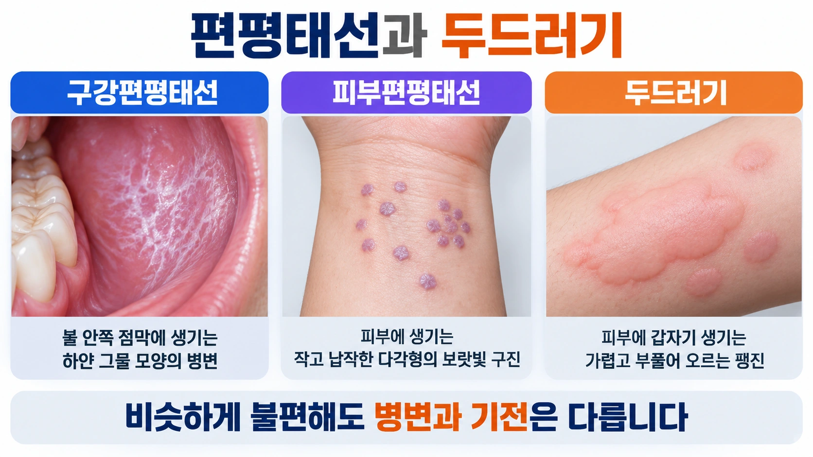 구강·피부 편평태선, 두드러기·알레르기와 어떤 관련이 있을까요?