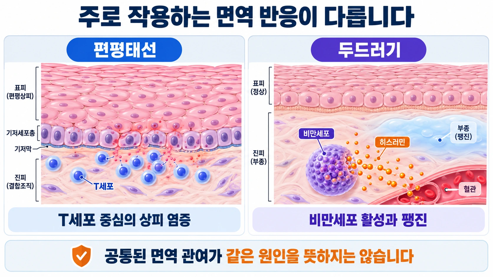 T세포와 상피 손상이 중심인 편평태선, 비만세포와 히스타민이 중심인 두드러기 기전 비교